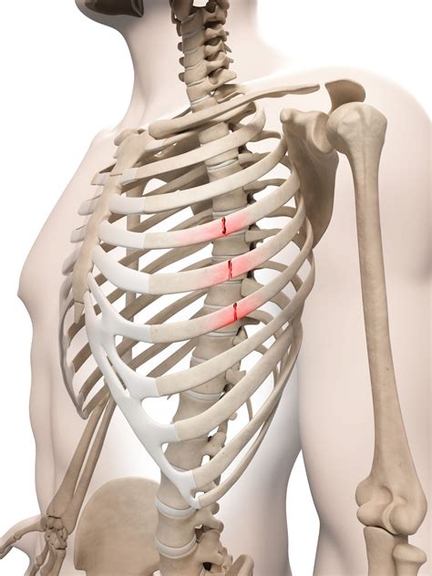 Treatment options for isolated <b>musculoskeletal chest wall pain</b>*. . 12th rib fracture